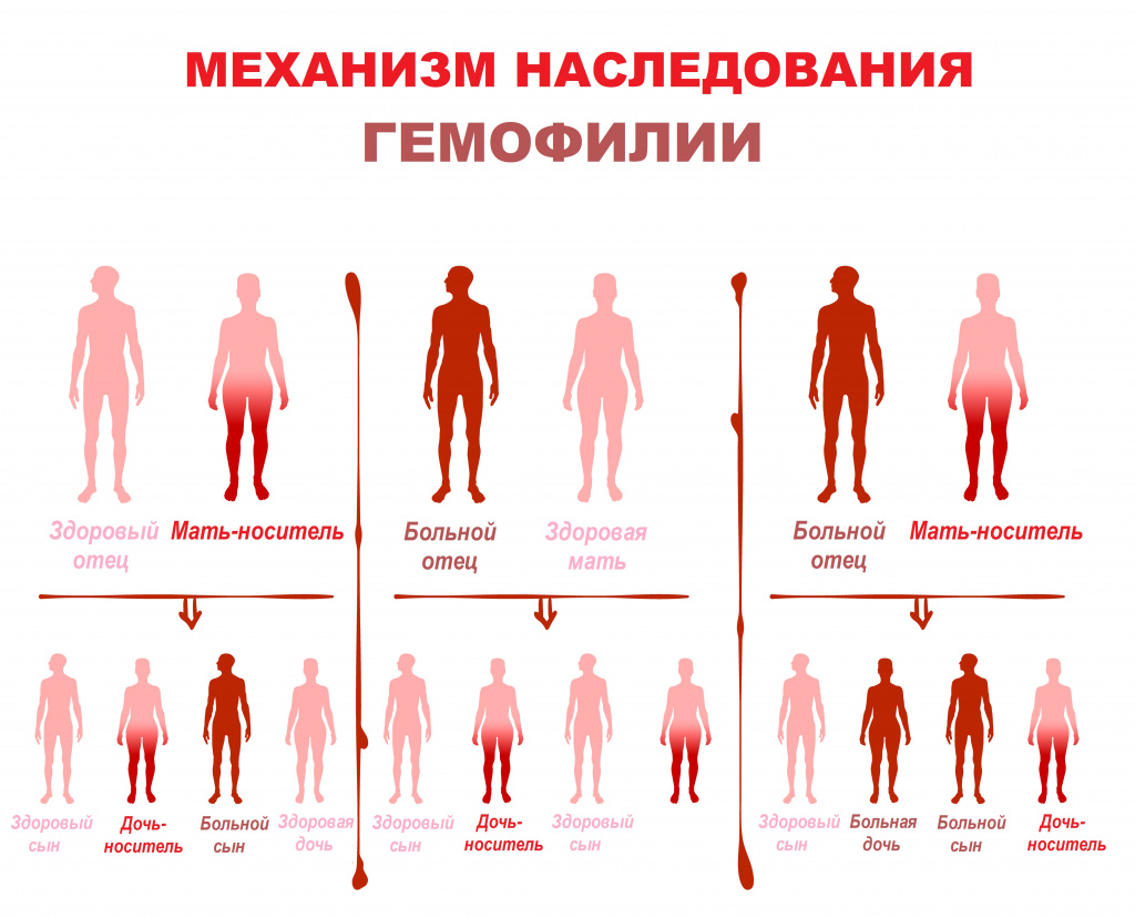 hemophilia inheritance mechanism